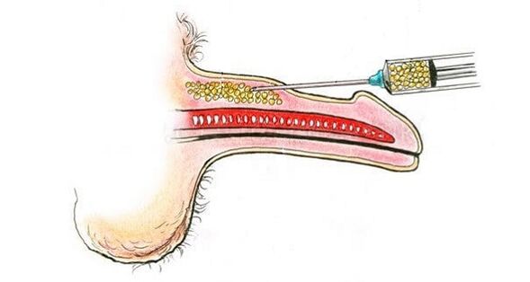 Inxeccións de ácido hialurónico no transcurso dun membro para aumentalo